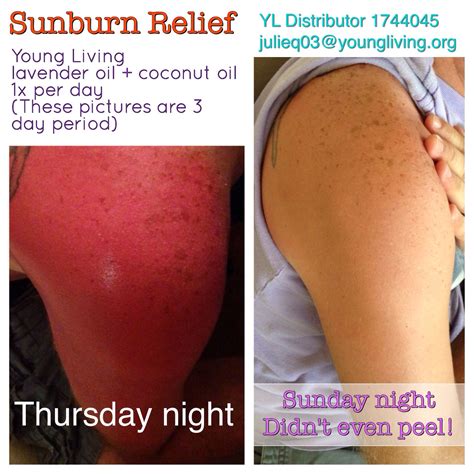 Does Vitamin E Oil Help Sunburn
