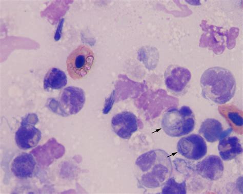 Fig 3 Fluid From Cyst 1000x Eclinpath