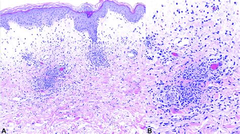 A, Biopsy of a papulovesicle demonstrates papillary dermal edema and a... | Download Scientific ...