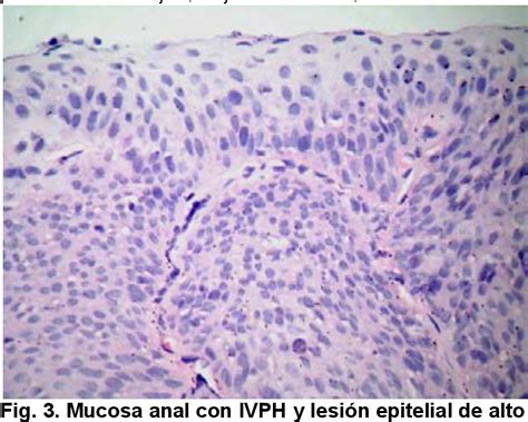 Neoplasia Intraepitelial Anal Semantic Scholar