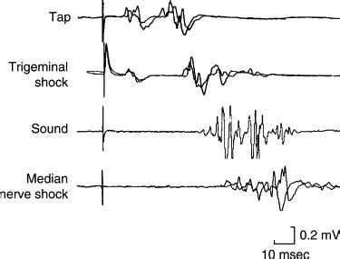 The Blink Reflex and Other Cranial Nerve Reflexes | Neupsy Key