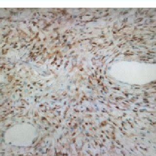 Histopatology Image The Tumor Cells Are Diffusely Positive For Cd