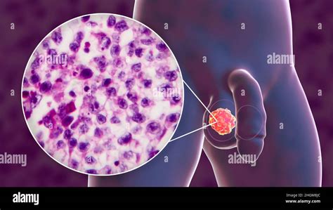 Cancer du testicule illustration et micrographe léger Photo Stock Alamy