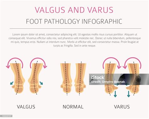 Vetores De Deformação Do Pé Como Infográfico De Desânimo Médico Defeito