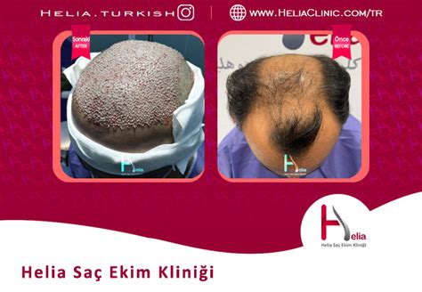 Türkiye nin en iyi doktor ve saç ekimi merkezleri Helia Kliniği