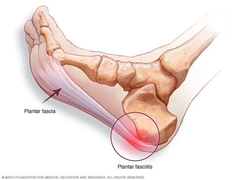 Plantar Fasciitis A Common Cause Of Foot Pain Orthopedic Center For Sports Medicine Sports