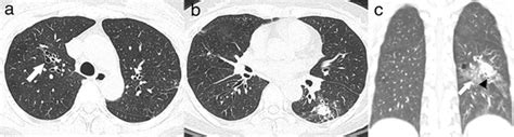 A 53 Year Old Woman With Hemoptysis And A Fungus Ball A Chest Computed