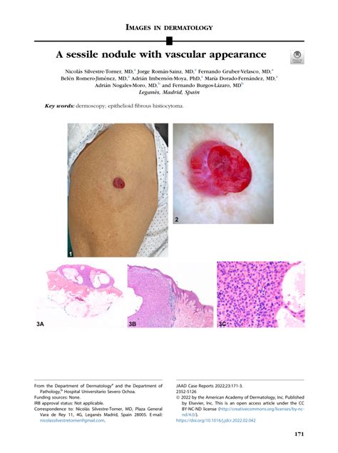 Pdf A Sessile Nodule With Vascular Appearance