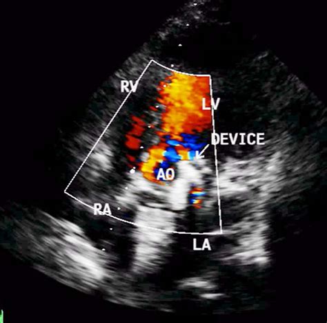 paravalvular leak plug outcomes  paravalvular leak closure dfwnri