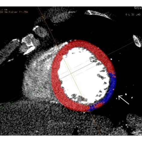 Short Axis First Pass Ct Perfusion Images Demonstrating An Area Of Low