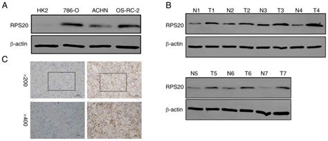 Biochemical and clinical effects of RPS20 expression in renal clear ...