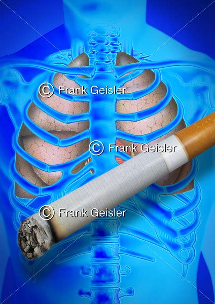 Medical Art Lunge COPD Und Lungenkrebs Durch Rauchen Medical Pictures