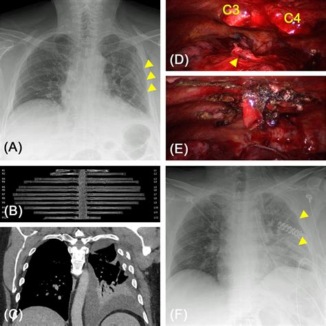 Frontiers Is It Necessary To Stabilize Every Fracture In Patients