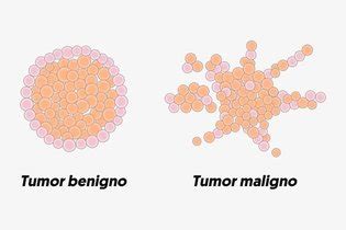 Neoplasia maligna o que é sintomas causas e tratamento Tua Saúde