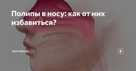 Полипы в носу: как от них избавиться? | ЛОР КЛИНИКА ЗАЙЦЕВА | Дзен