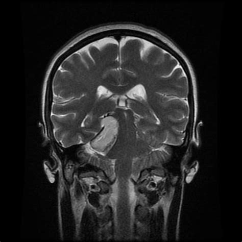 Ruptured Intracranial Dermoid Cyst Image