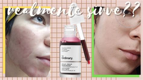 3 Meses Usando The Ordinary Peeling Solution Aha 30bha 2 Antes Y