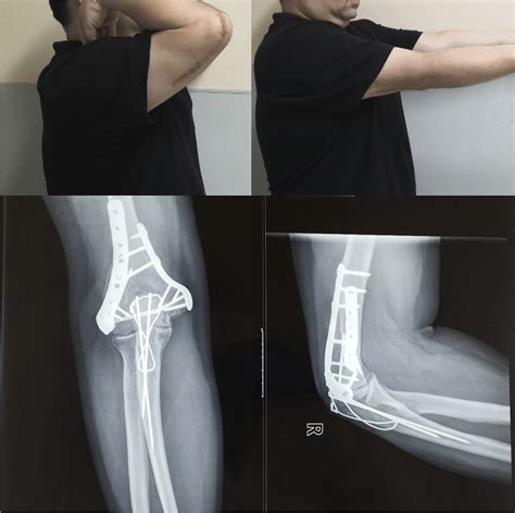 Axial Elbow X Ray Positioning