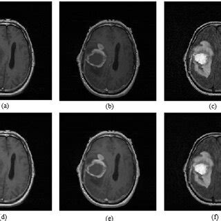 (a) T1 image; (b) T1C image; (c) FLAIR image; (d) median-filtered T1 ...