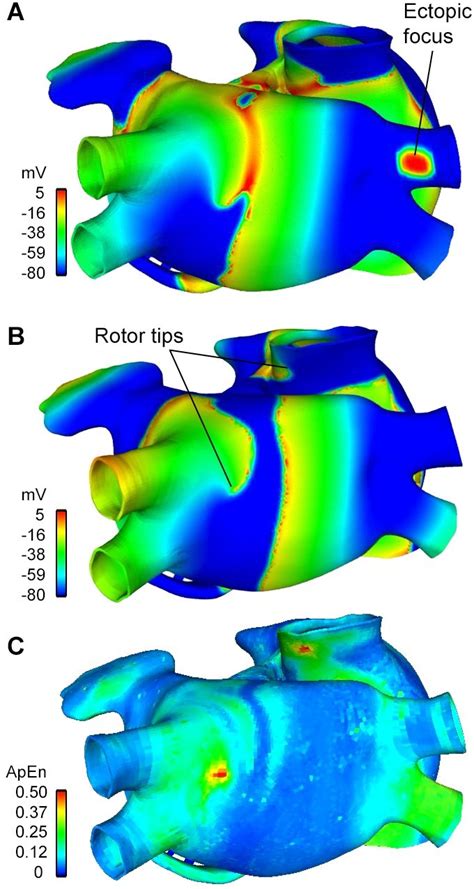 A Chronic Af Propagation Ectopic Focus Location Are Shown B Chronic