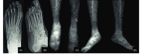 A Anteroposterior And B Oblique Right Foot S X Ray Of 28 Year Old