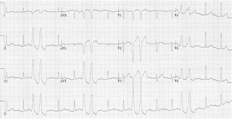 ECG PVC Examples