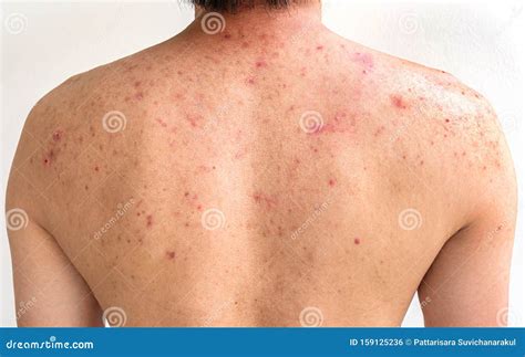 Hombres Con AcnÃ© Con Manchas Rojas En La Espalda Foto De Archivo