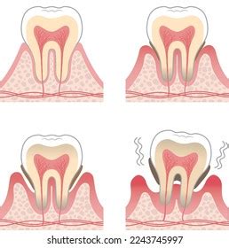 Tooth Illustration Progression Periodontal Disease Stock Vector