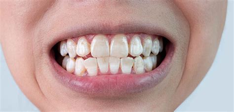 How To Avoid White Spots After Braces Round Lake Orthodontist Answers