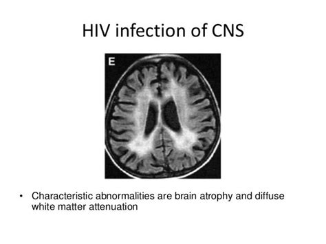 Cns infections radiology.