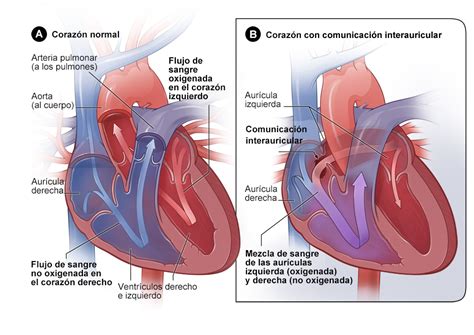 Cardiopat As Cong Nitas Tipos Nhlbi Nih