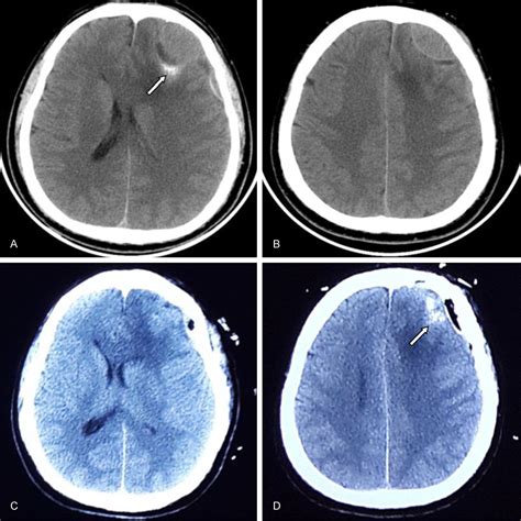 Figure From Extensive Epidural Extension Growth Of A Glioblastoma A