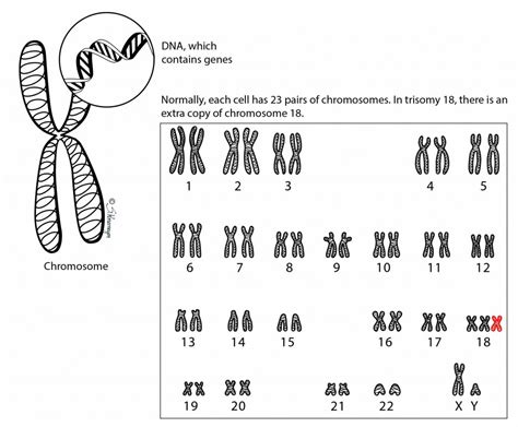 Trisomy 18 – Ohio Fetal Medicine Collaborative