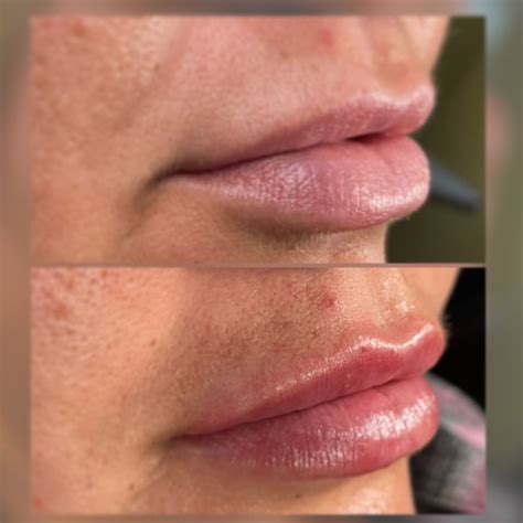 Allure Aesthetics Denver Updated January 2025 Request An