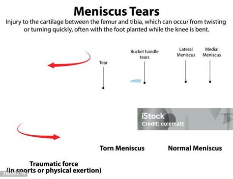 Illustration Of Torn And Normal Meniscus Stock Illustration Download