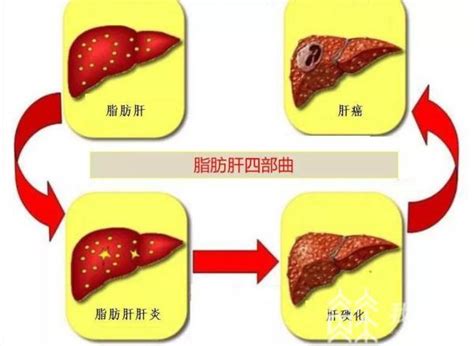 不要轻视脂肪肝 权威专家提醒：远离危险因素，高危人群早期筛查