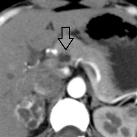 -Open arrow showing pancreatic cyst in body of pancreas. | Download ...