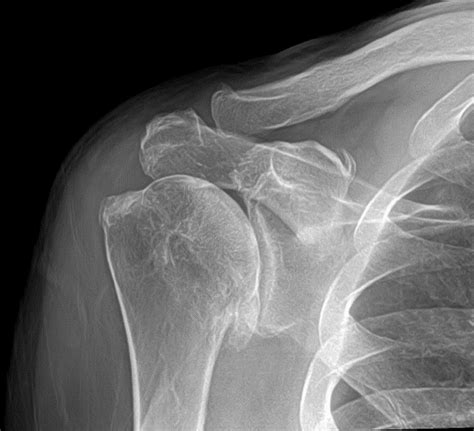 Shoulder Arthritis Surgery