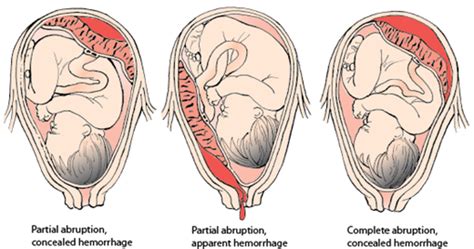 Abruptio Placentae Placental Abruption