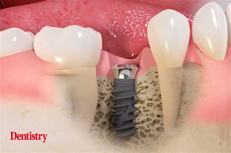 Tissue Level Implants What Are The Benefits Dental Implants Chula