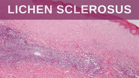 Lichen Sclerosus Pathology Mini Tutorial Youtube