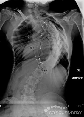 Mild Scoliosis X Ray