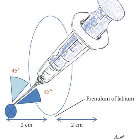 Direction of proper needle insertion. Inserting the needle at a ...