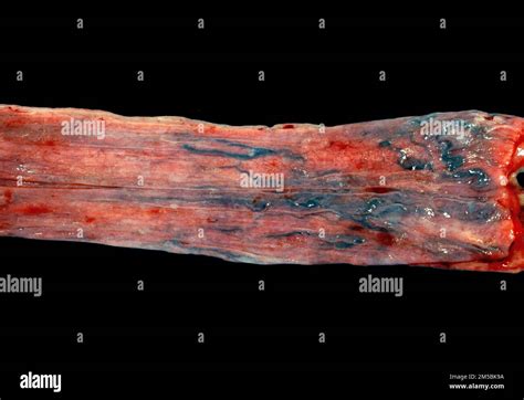 Close Up Of The Inner Surface Of A Human Oesophagus Showing Oesophageal
