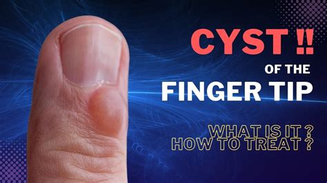 Finger Mucous Cyst - Video Spotter