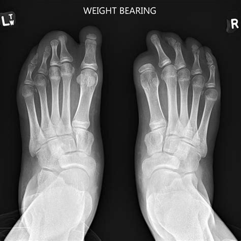 Amniotic band syndrome | Radiology Case | Radiopaedia.org | Radiology, Radiology imaging ...