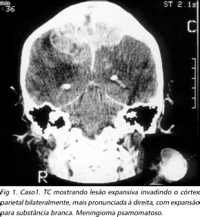 SciELO Brasil Dor central devida a compressão do cortex parietal