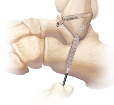 Anatomic Reconstruction Of Anterior Talofibular Ligament 42 OFF