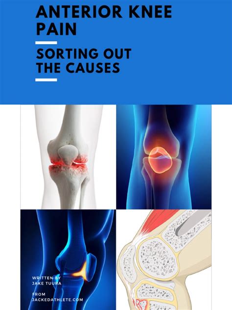 Anterior Knee Pain - Sorting Out The Causes | PDF | Knee ...