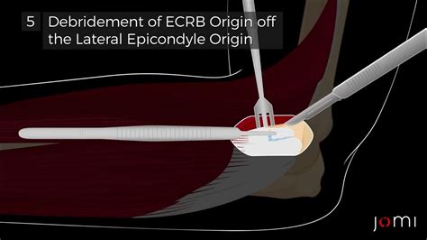 Lateral Epicondylitis Debridement - YouTube